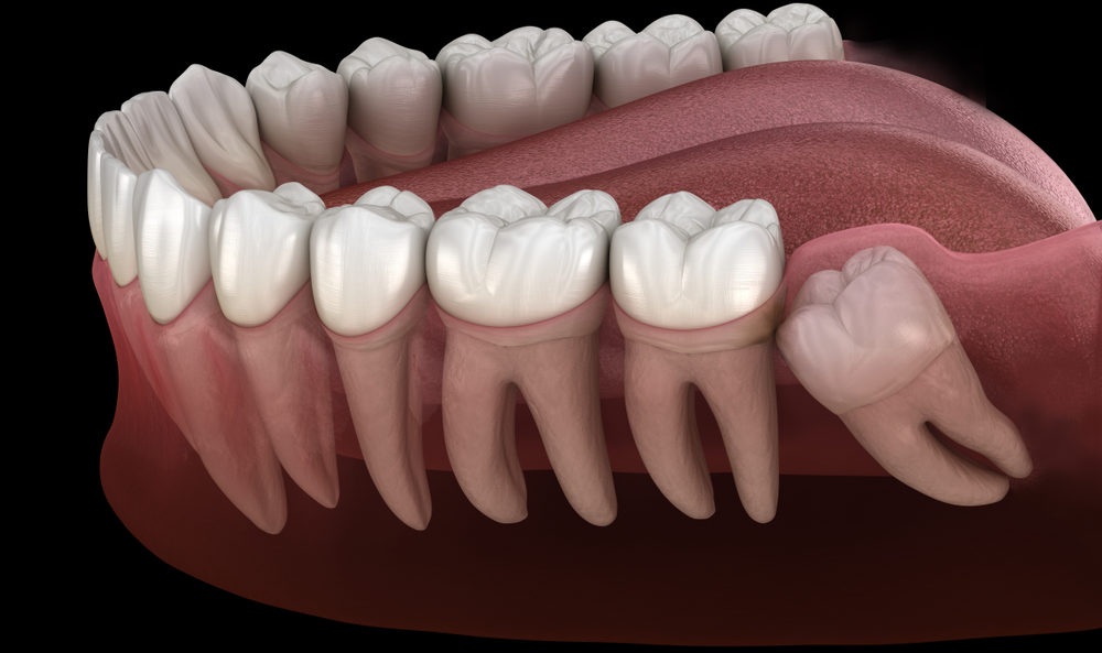 Healthy Teeth And Wisdom Tooth With Mesial Impaction