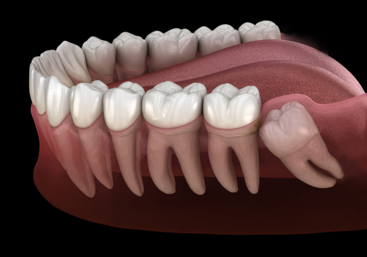 Healthy Teeth And Wisdom Tooth With Mesial Impaction
