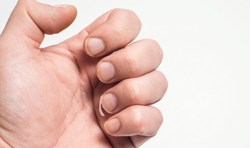 Close-Up Of Bitten And Brittle Nails. A Broken Nail